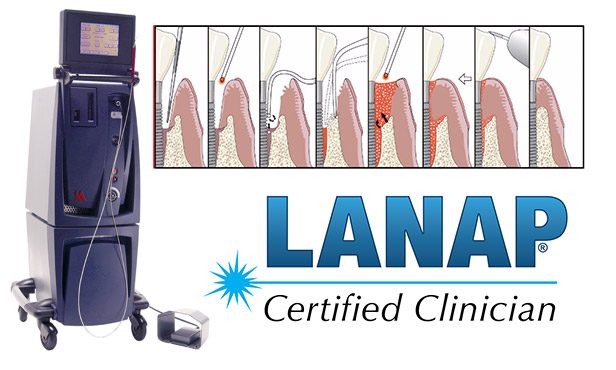LANAP Laser Treatment